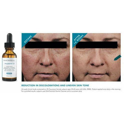 Phloretin CF Results Skinceutcals Canada Authorized Retailer Phloretin CF review Mississauga Toronto Canada Skinceuticals Canada Phloretin CF Before and After Canada