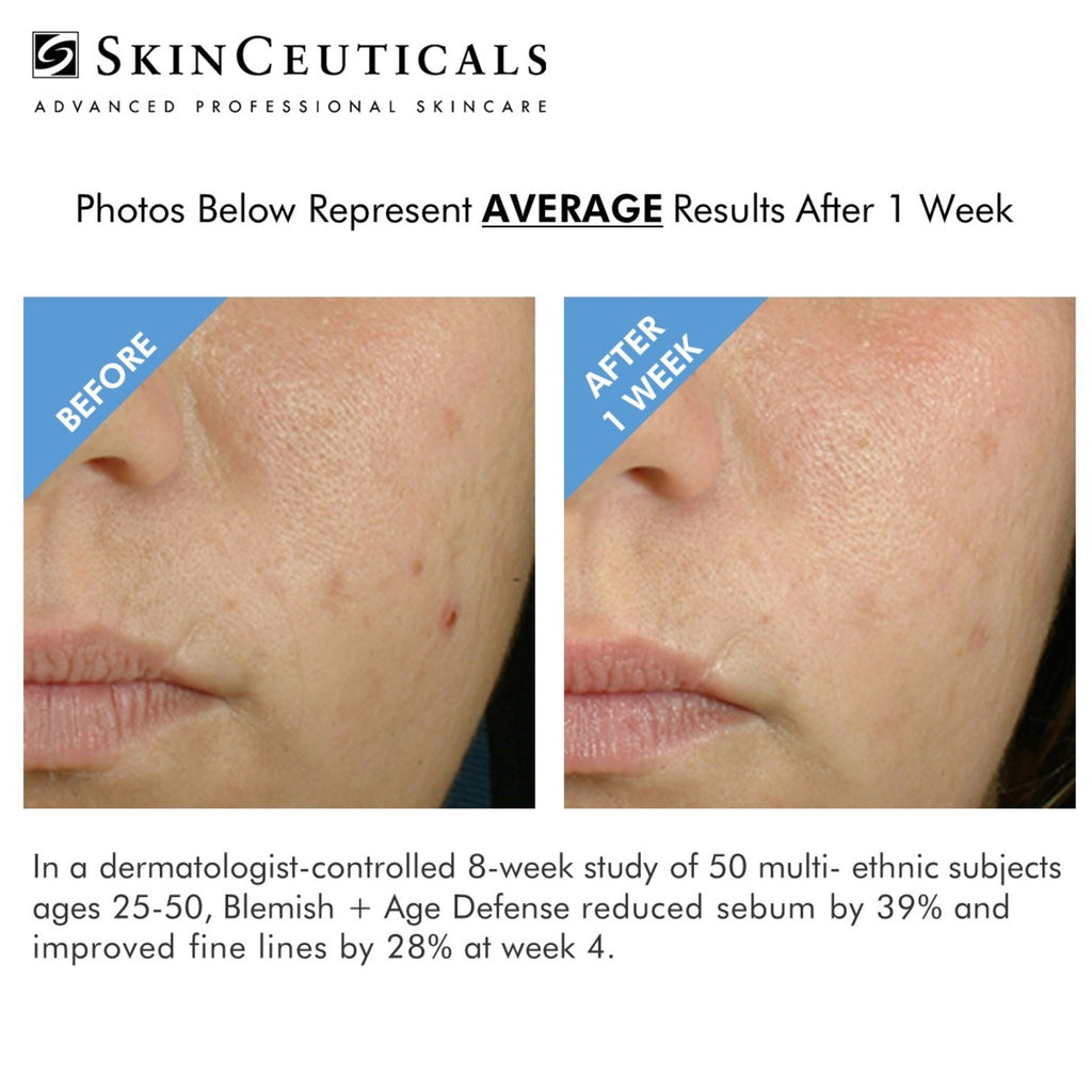 Blemish and Age Result Skinceuticals Canada Blemish and age reviews Blemish and Age Authorized Retailer Canada Skinceuticals Sale Promo 
